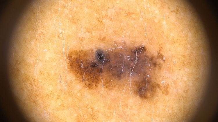 Melanoma in situ ALM 04022.JPG